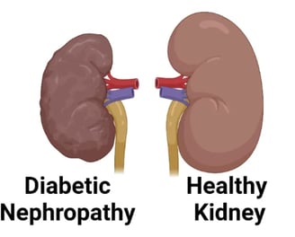 Get Best Diabetic Nephropathy Treatment In Hyderabad