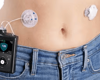 insulin pump therapy