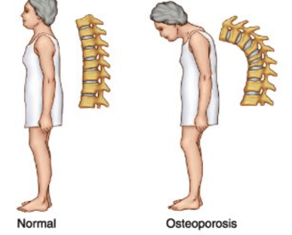 osteoporosis