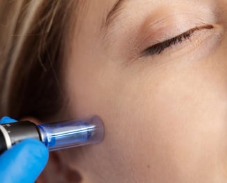 Anwendung der Microneedling Technologie mithilfe eines Pen