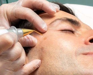 Plasma Pen Anwendung an einem Mann