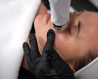 Radiofrequenz Microneedling Behandlung an einer Frau