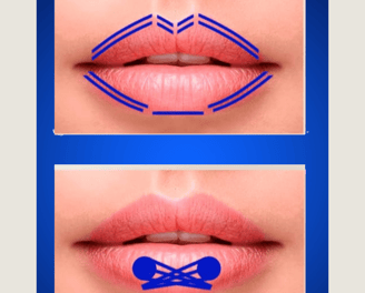 Técnica de preenchimento labial