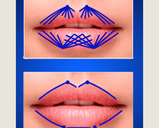 Técnica de preenchimento labial