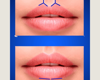 Técnica de preenchimento labial
