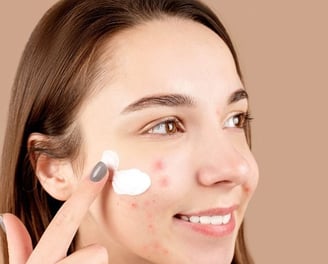 woman putting medicine on her acne