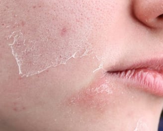 woman with dry skin