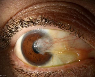 foto demonstrando o pterígio, carne crescida dos olhos, cirurgia de pterígio, olho seco