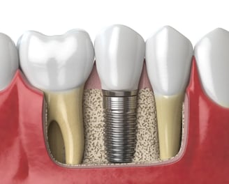 Impianto dentale dente