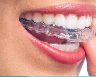 Mascherine invisibili, Invisalign, Clear Correct