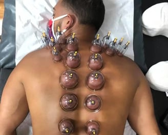 cupping therapy session with patient on supine wearing a mask. 