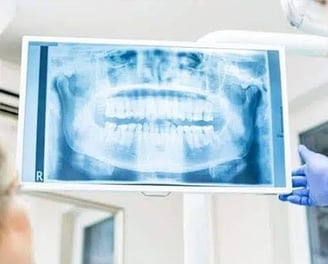 X-Ray of whole mouth front view
