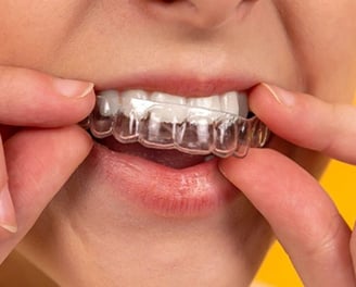 transparent dental aligner