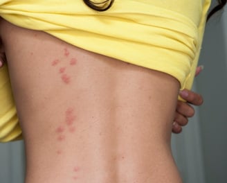 a woman's exposed back shows recent bed bug bites