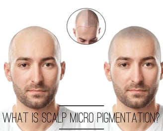 Skindent's Rejuvenate Scalp Micro Pigmentation Services