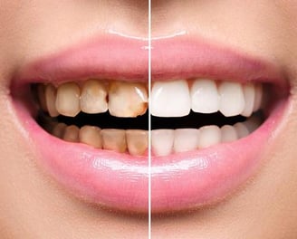 a woman's teeth whitening and a smile