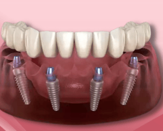 a dental implanting implanting teeth and implants