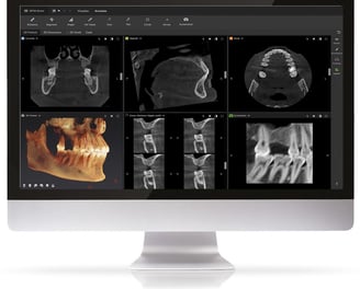 Tac Cone Bean progettazione di un caso clinico
