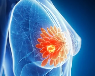 breast cancer 