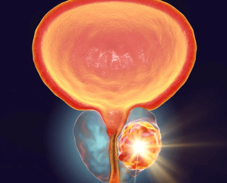 prostrate cancer
