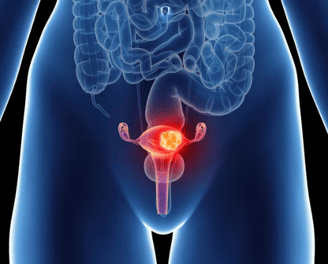 gynaecological cancer