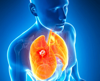 Lung Cancer