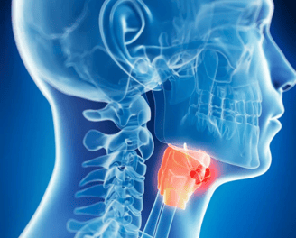 throat cancer