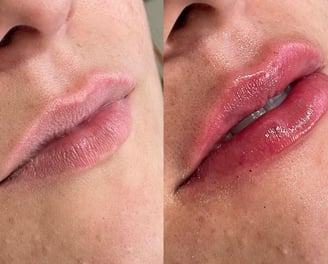 Preenchimento labial natural, sem exageros. Tecnica lipkiss