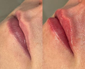 Preenchimento labial natural, sem exageros. Tecnica lipkiss
