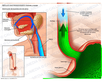 Imagen de Reflujo Gastroesofágico utilizado en la pagina web de la Dra. Arlenis Guzmán 