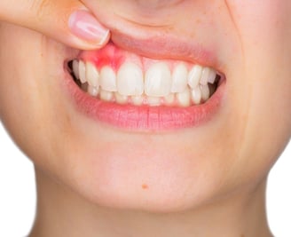 viêm lợi là gì