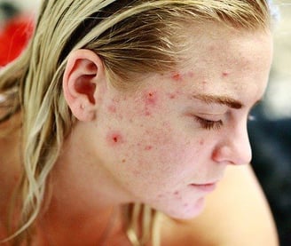 location of acne