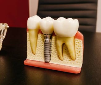 Dental Implants Treatment in Pune