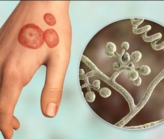 Ringworm Infections