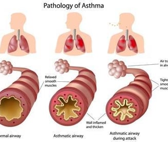asthma