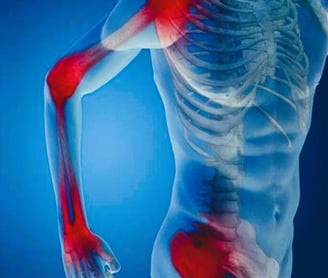 Arthritis Symptoms