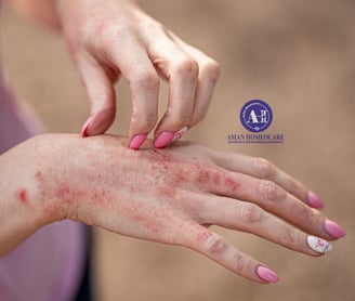 Contact Dermatitis