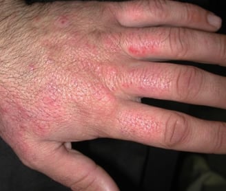 Irritant Contact Dermatitis