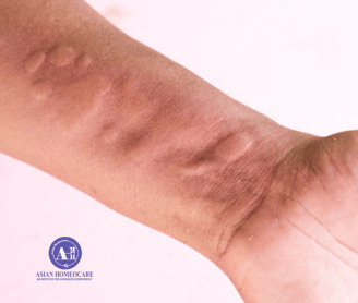 Urticaria Homeopathic treatment