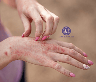 Contact Dermatitis Homeopathic Treatment