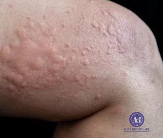 Urticaria Homeopathic Treatment