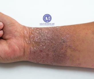 Eczema, Atopic Dermatitis