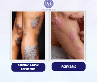 Eczema vs Psoriasis