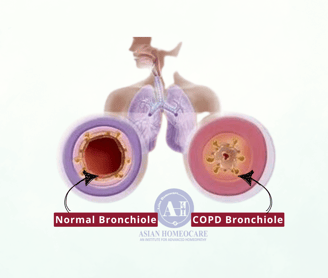 COPD