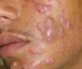 Doença inflamatória que envolve as glândulas sebáceas (que produzem oleosidade)