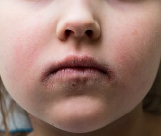 doença que provoca manchas avermelhadas e ressecadas no corpo, que coçam muito.