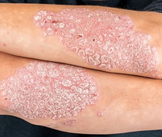 uma pessoa com psoríase, manchas avermelhadas cobertas de escamas esbranquiçadas que coçam