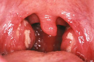 Cryptic Tonsillitis