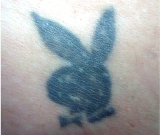 electrolysis-and-tattoos