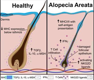 alopecia areata
